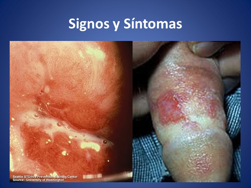 infecciones de transmision sexualidad en mujeres sintomas infecciones de transmision sexualidad en mujeres sintomas